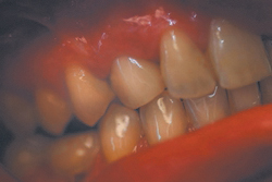 dental implants middlesex after