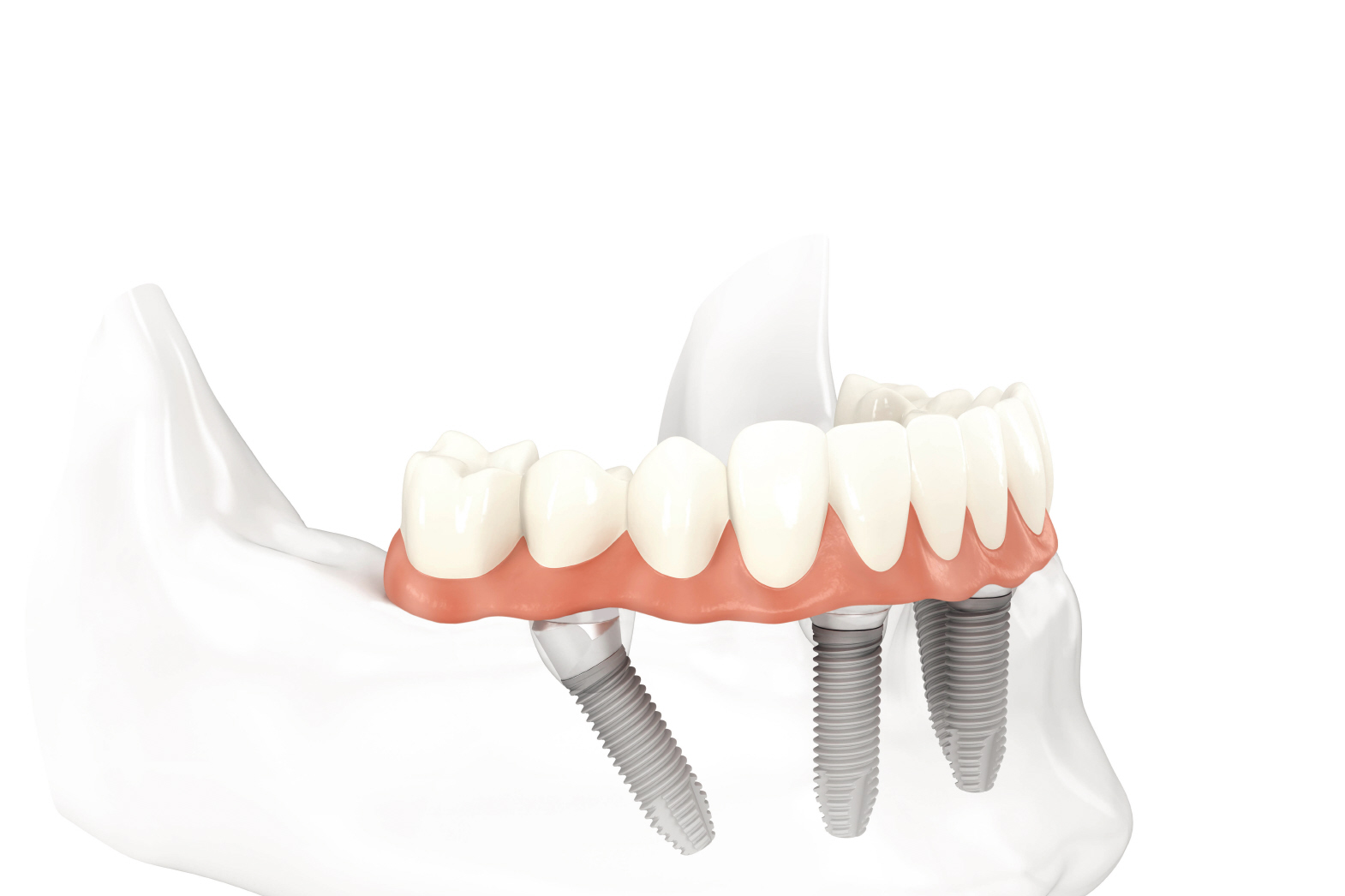 Dr. Pete Spalitto, All-on-4 dentist in St. Louis, MO.
