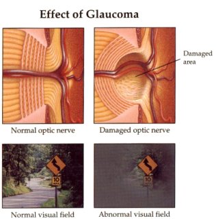 Effect of Glaucoma