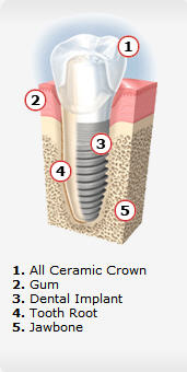 Dental Implant - Overland Park Dental Implants