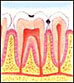 tooth decay