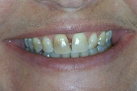 Porcelain veneers - before
