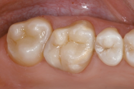 CEREC inlay after