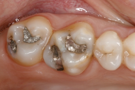 CEREC inlay before