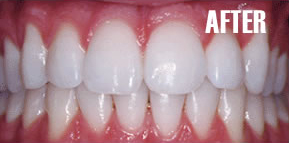 Tooth Whitening Scottsdale - Dental Bleaching Gilbert - Free Tooth whitening - Mesa Cosmetic Dentist