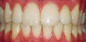 Mesa Dental Whitening - white teeth - Bleaching Mesa - Tooth Whitening Gilbert