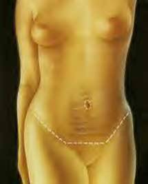 type of incision for tummy tuck Montreal
