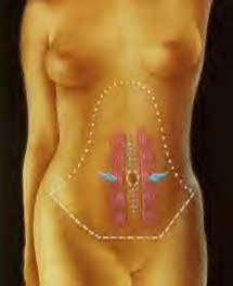 surgical process for tummy tuck Montreal