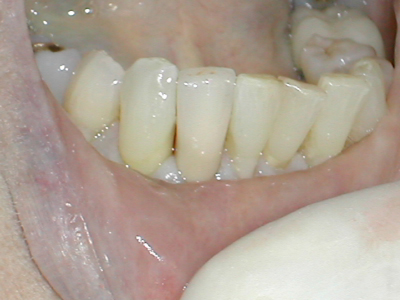 Dr. Neil McLeod prosthodontist, prosthodontics, cosmetic dentistry, cosmetic dentist, west hollywood dentist, Los Angeles dentist.