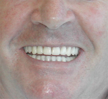 If teeth are missing, Los Angeles dentist Dr. Neil McLeod, can replace them with dentures for the health of your mouth, as well as for appearances sake. If you don't replace missing teeth, you will find it harder to keep your gums and your other teeth  Dental Bridge,TMJ Disorders,Veneers,Teeth Bleeching,Implant Dentist,Cosmetic dentist,Porcelain facings,General Dentist,Dentist,Dental,Tooth,Dentures,Cosmetic Dentistry,Dental Implants,Implant,Smile,Prosthodontist,Dentistry,Prosthodontics,Teeth Whitening,denture,partial denture,precision attachment