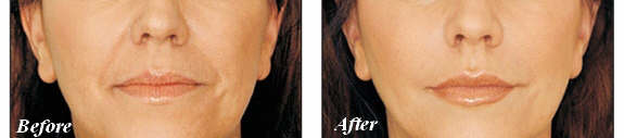 Juvederm_before_after