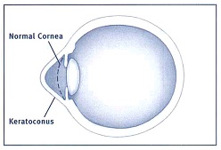 Keratoconus