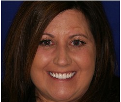 Porcelain Veneers by Danville California cosmetic dentist Dr. Christopher Pescatore