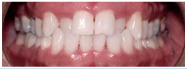 A patient at our office in Yorba Linda, before using Invisalign.