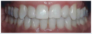 A patient at our office in Yorba Linda, after using Invisalign.