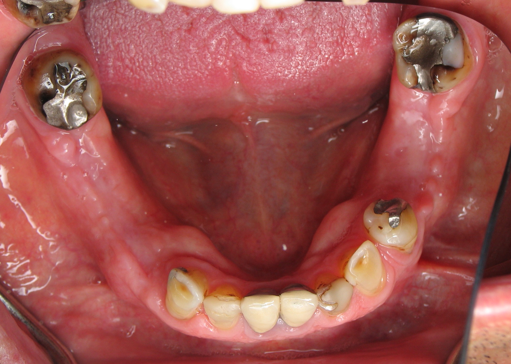 After Jaw bone Widening