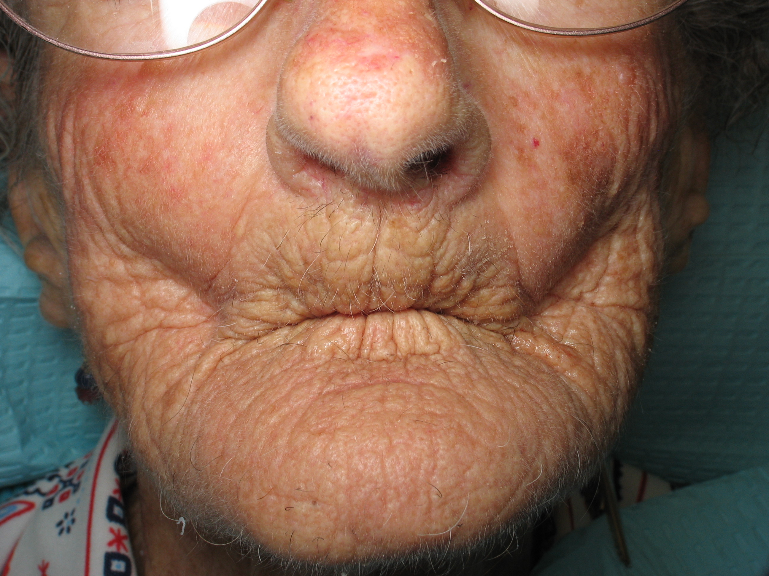 face collapse due to bone loss