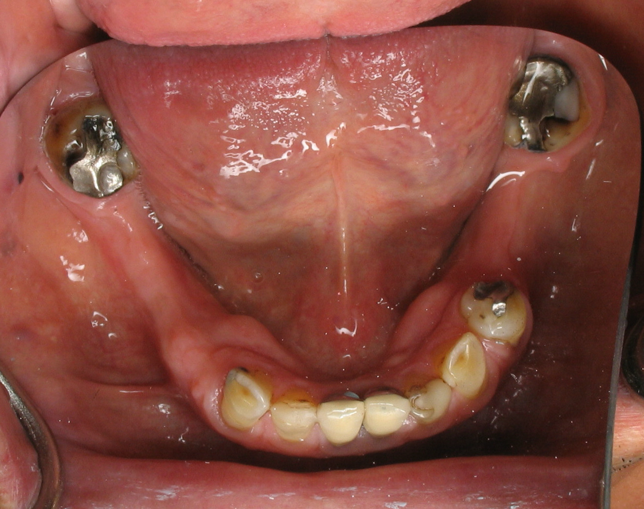Bone too skinny for dental implants