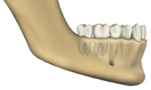No bone loss
