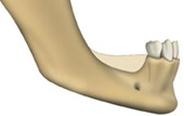 Bone loss