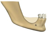 Severe bone loss