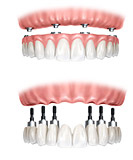 Dental Implants -Full mouth
