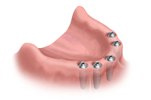 In this case - 5 Dental Implants are placed