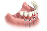 Fixed Bridge attaches to Dental Implants 
