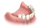 Lower Fixed Dental Implants