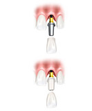 Single tooth dental implant