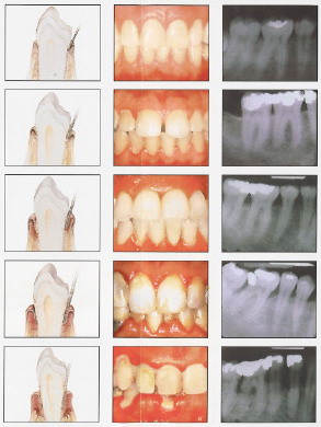 Stages of Gum Diease