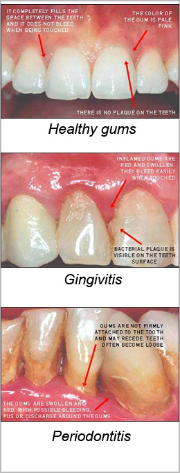 Stages of Gum Disease