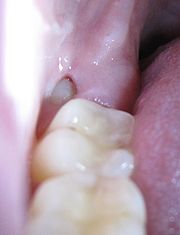 Wisdom Tooth Causing Pain