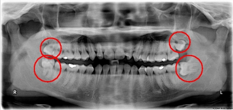 Burbank Wisdom Teeth Extractions