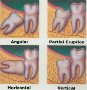 Wisdom tooth impaction