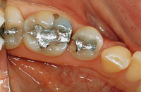 Before Cerec