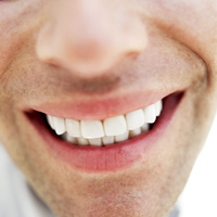 Laguna Niguel teeth whitening