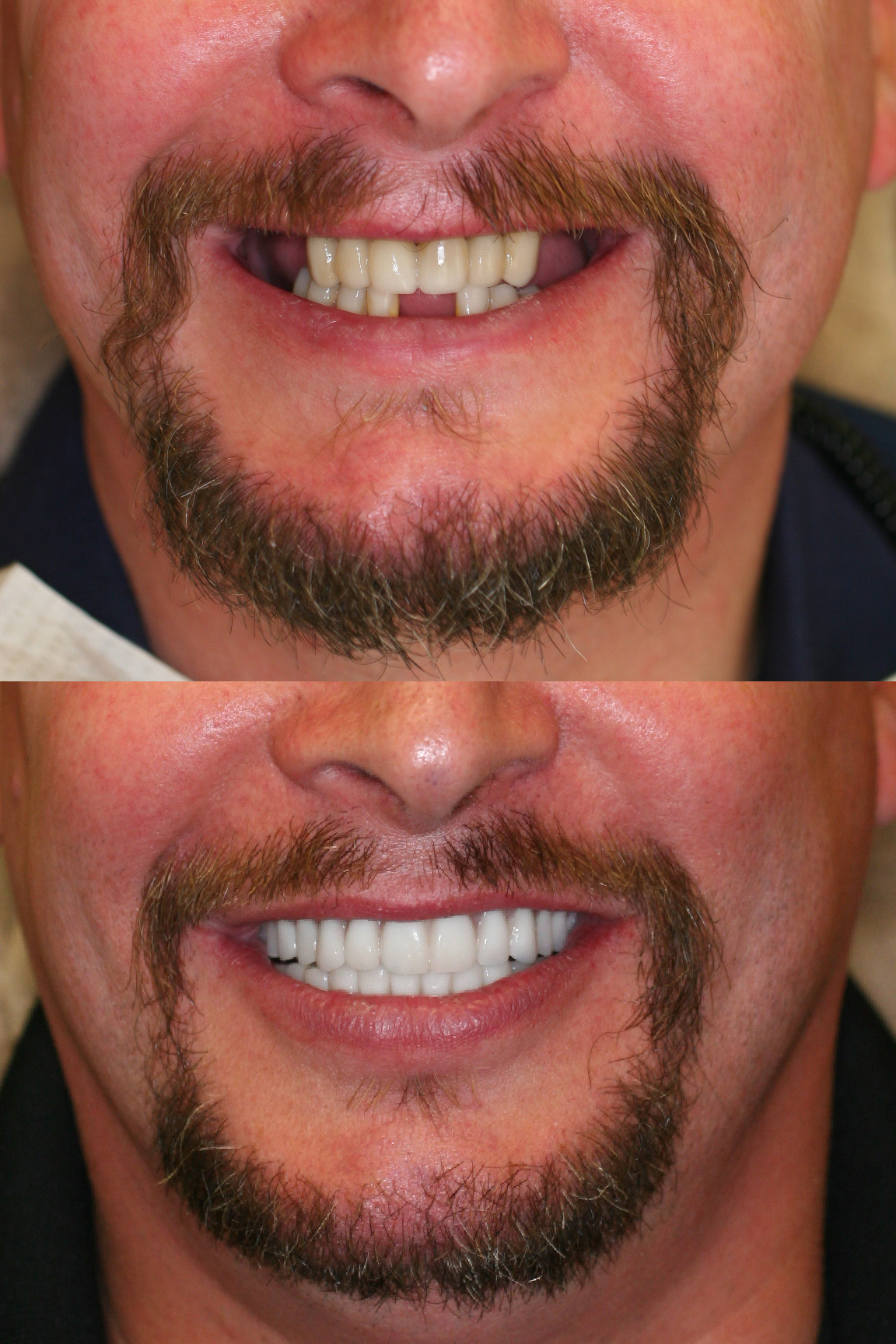Teeth in a Day