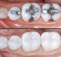 Dental Inlays
