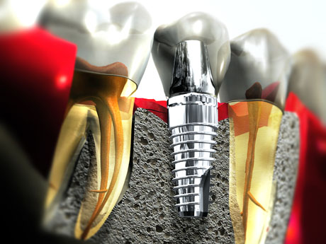 Single Tooth Implants
