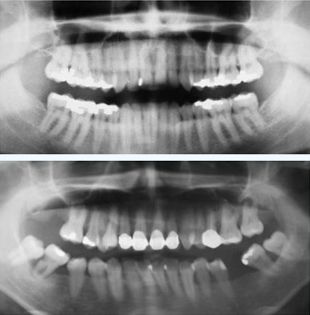 Digital Dental X-rays
