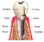 dental implant