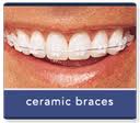 Ceramic Orthodontic Braces