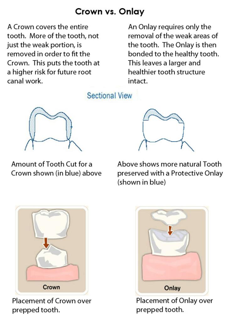 Dental Treatments -- Crowns vs. Onlays