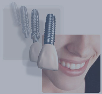 Dental Implants at Plaza Health Dentistry