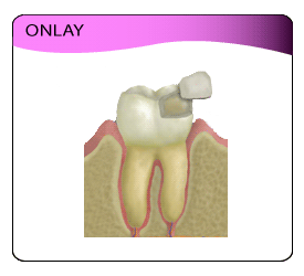 Expert Dental Treatment -- Onlay
