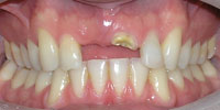 missing teeth