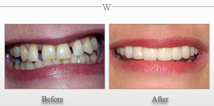 Dental Implant Reconstruction