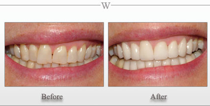 Porcelain Veneers
