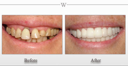 full mouth reconstruction